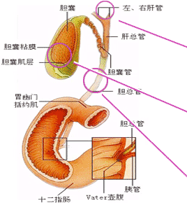 胆结石