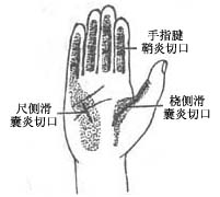 ⑵手指化脓性腱鞘炎,尺侧滑囊炎与桡侧滑囊炎切口