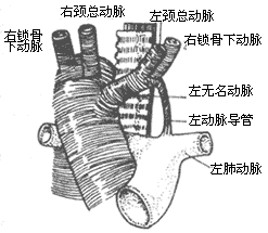 (1)右位主动脉弓