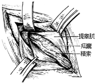 3-6 拉开腹内斜肌,腹横肌,切开提睾肌