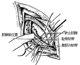 一般腹股沟斜疝修复术