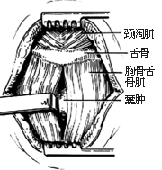 2-3 分开胸骨舌骨肌