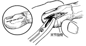 脓性指头炎切开引流术