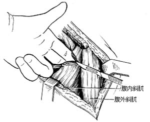 ⑷切开前纵韧带,结扎腰动,静脉(附图示腰动,静脉位置)
