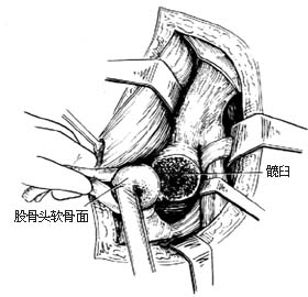 髋关节结核病灶清除术