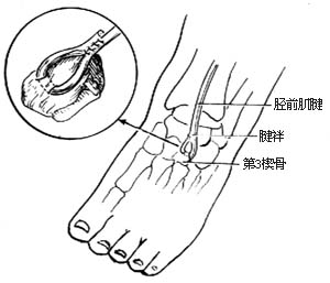 胫前肌腱转移术