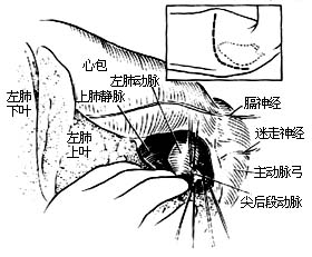6-1 切开肺门上缘纵隔胸膜,显露,结扎,切断迷走神分支及左肺动脉上