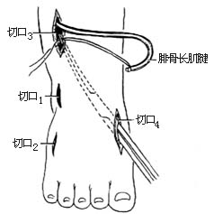 腓骨长肌腱转移术