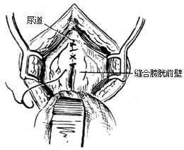 ⑼缝合膀胱前壁
