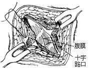 图34 游离回肠开口引出输尿管导管 图35 下腹壁人工膀胱瘘口