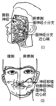 面神经手术